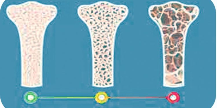 হাড়ের ডেনসিটি কমছে,ভুগতে পারেন নানা সমস্যায়