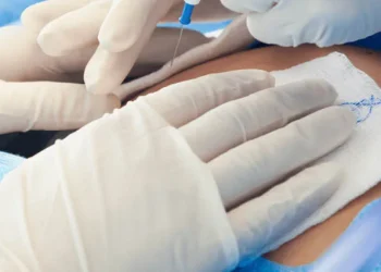 সিজারিয়ান অপারেশনের পর সেলাইয়ের স্থানে কতদিন ব্যথা থাকতে পারে