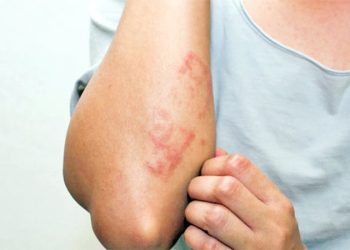 ডায়াবেটিস থেকে ত্বকের সমস্যা